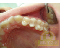 Реставрация зубов - фото до и после