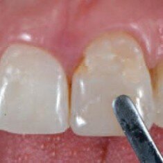Изготовление прямого шаблона для контроля правильной длины и пропорции зуба