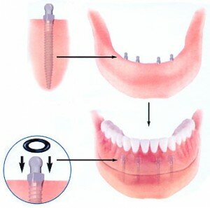 Протез может крепиться к соседним зубам или на мини имплантаты