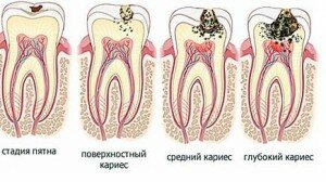 Лечение кариеса и других поражений зуба