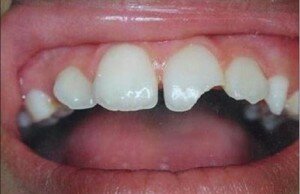 Механическое повреждение зуба