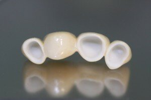 Безметалловые зубные мосты из диоксида циркония