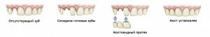 Выбор типа и установка зубного моста