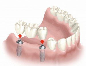Зубные мосты на имплантах
