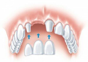 Зубные мосты, опирающиеся на здоровые зубы