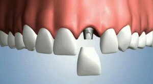 Имплантации передних зубов