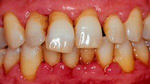 Хронические воспалительные заболевания тканей вокруг зуба
