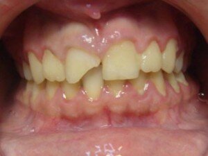 Физические травмы зубов