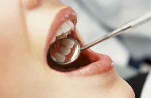 Метод лечения гингивита определяется стоматологом