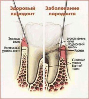 Чрезмерная подвижность зубов и пародонтит