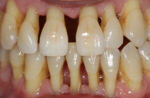 Ярко выраженные дефекты зубного ряда