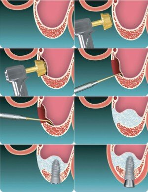 Синус-лифтинг решает вопрос имплантации зубов