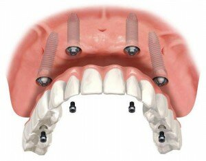 Имплантация зубов по методике all-on-four