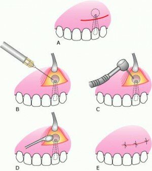 Зубосохраняющая операция апикоэктомии