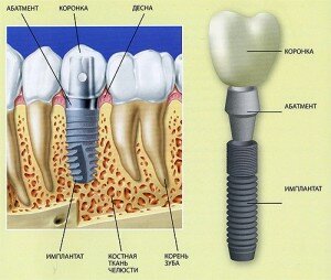 Имплантацию делают в центре хирургической стоматологии