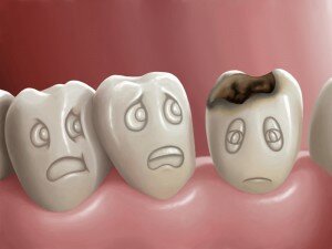 Кариес характеризуется разрушением зубной эмали и переходом процесса на неглубокие слои дентина