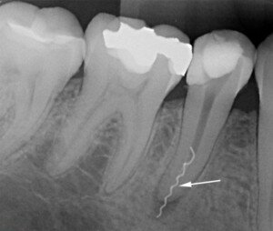 Извлечение инородного тела из зубного канала