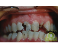 Имплантация зубов - фото до и после