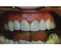 Имплантация зубов - фото до и после