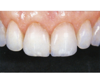 Эстетическая стоматология - фото до и после