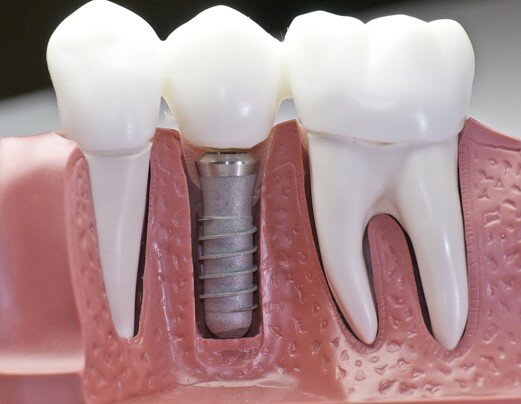 Имплант для протезирования зубов
