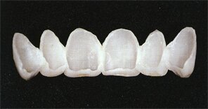 Виниры в стоматологии ДентаЛюкс-М