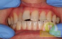 Реставрация зубов до